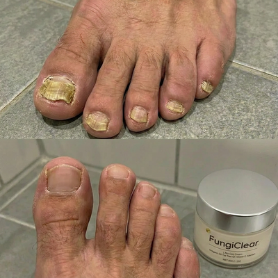 FungiClear