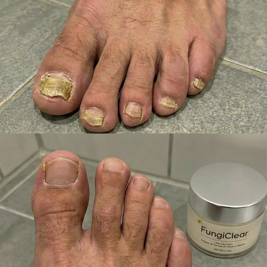 FungiClear